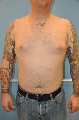 Gynecomastia Surgery before at Day Plastic Surgery (Norman Bakshandeh, MD) in Brooklyn, NY