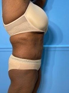 Mini Tummy Tuck after at Day Plastic Surgery (Norman Bakshandeh, MD) in Brooklyn, NY