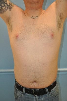 Gynecomastia Surgery before at Day Plastic Surgery (Norman Bakshandeh, MD) in Brooklyn, NY