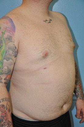 Gynecomastia Surgery after at Day Plastic Surgery (Norman Bakshandeh, MD) in Brooklyn, NY