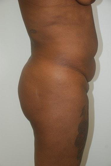 Brazilian Butt Lift before at Day Plastic Surgery (Norman Bakshandeh, MD) in Brooklyn, NY