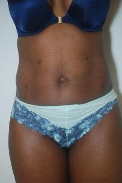 Brazilian Butt Lift before at Day Plastic Surgery (Norman Bakshandeh, MD) in Brooklyn, NY