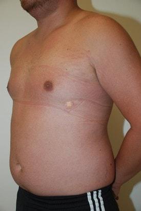 Gynecomastia Surgery after at Day Plastic Surgery (Norman Bakshandeh, MD) in Brooklyn, NY