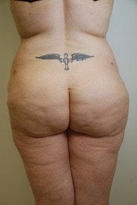 Brazilian Butt Lift before at Day Plastic Surgery (Norman Bakshandeh, MD) in Brooklyn, NY