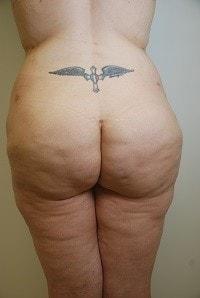 Brazilian Butt Lift after at Day Plastic Surgery (Norman Bakshandeh, MD) in Brooklyn, NY