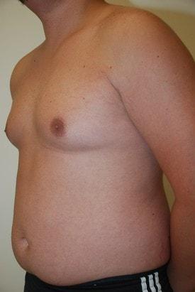 Gynecomastia Surgery before at Day Plastic Surgery (Norman Bakshandeh, MD) in Brooklyn, NY