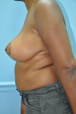 Mini Tummy Tuck after at Day Plastic Surgery (Norman Bakshandeh, MD) in Brooklyn, NY