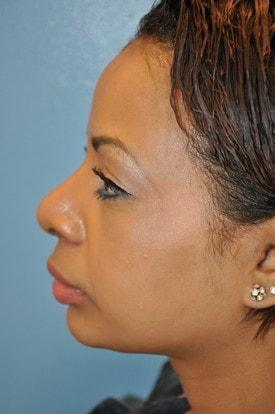 Day Plastic Surgery (Norman Bakshandeh, MD) rhinoplasty after — Brooklyn, NY
