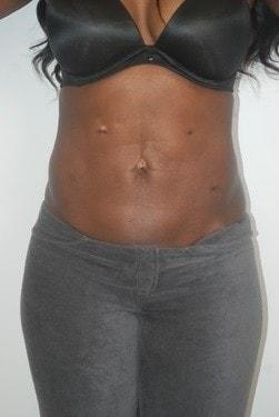 Brazilian Butt Lift after at Day Plastic Surgery (Norman Bakshandeh, MD) in Brooklyn, NY