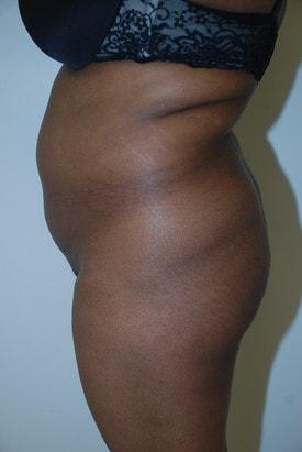 Brazilian Butt Lift before at Day Plastic Surgery (Norman Bakshandeh, MD) in Brooklyn, NY