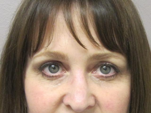 Brow Lift after at Caroline Min, MD in Pasadena, CA