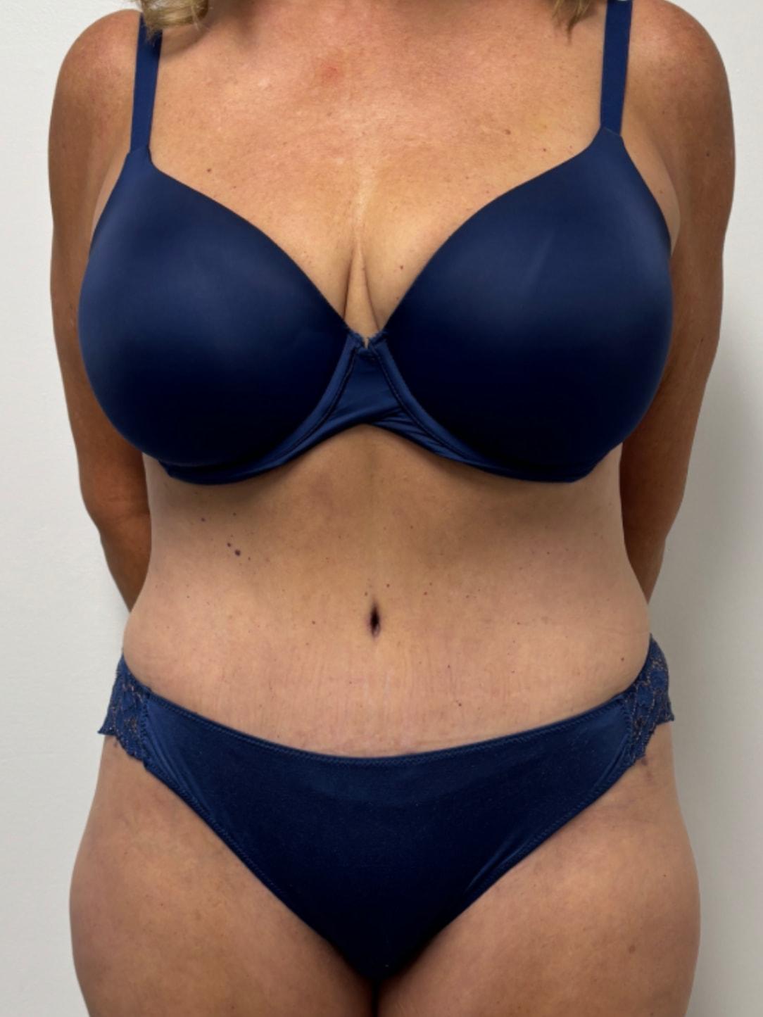 Caroline Min, MD tummy tuck after — Pasadena, CA