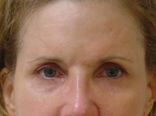 Brow Lift before at Caroline Min, MD in Pasadena, CA