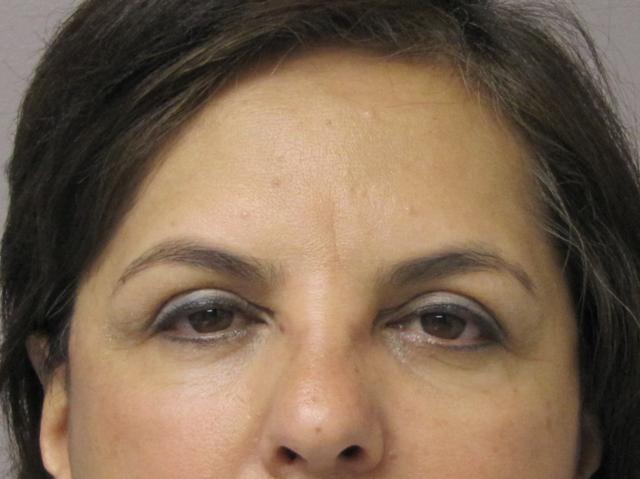 Brow Lift before at Caroline Min, MD in Pasadena, CA
