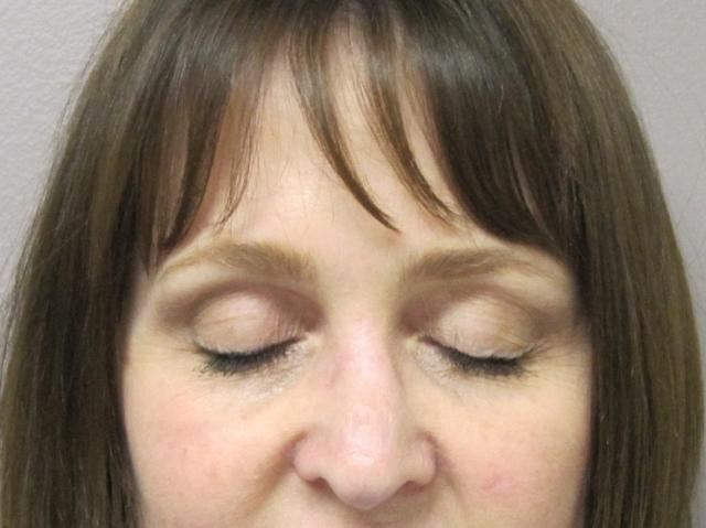 Brow Lift after at Caroline Min, MD in Pasadena, CA