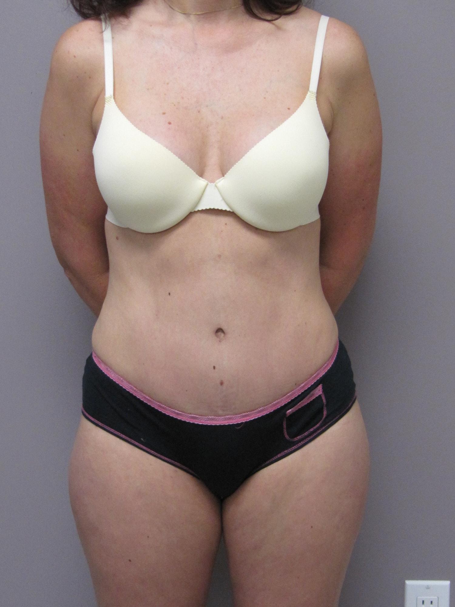 Caroline Min, MD tummy tuck after — Pasadena, CA