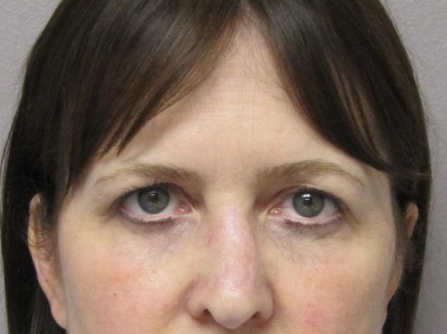 Brow Lift before at Caroline Min, MD in Pasadena, CA