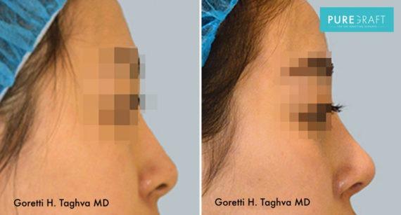 Brazilian Butt Lift result at LEA Plastic Surgery - Goretti Ho Taghva MD, FACS in Newport Beach, CA