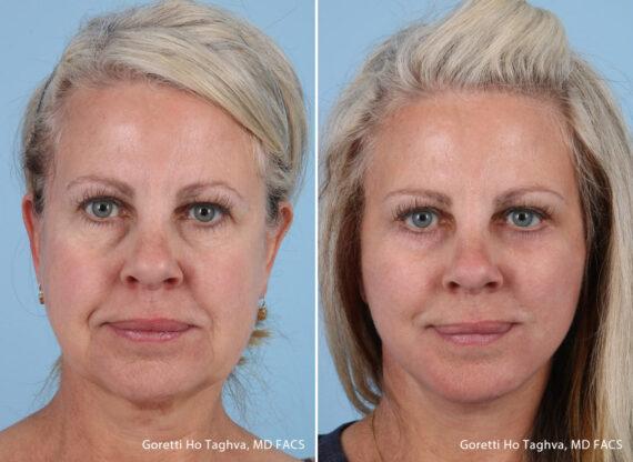 LEA Plastic Surgery - Goretti Ho Taghva MD, FACS facelift result — Newport Beach, CA