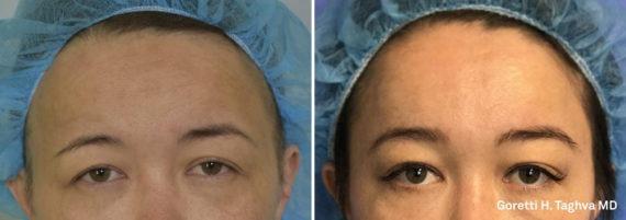 Brow Lift result at LEA Plastic Surgery - Goretti Ho Taghva MD, FACS in Newport Beach, CA