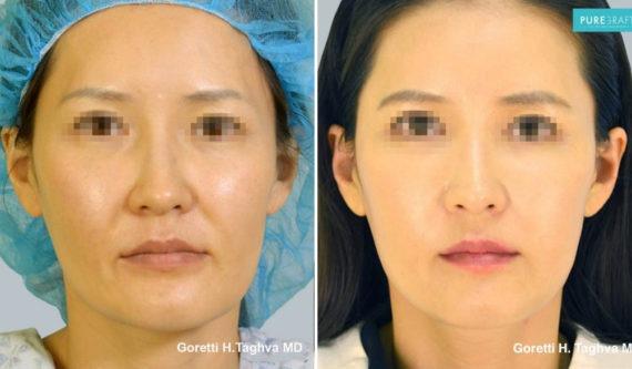 Fat Transfer result at LEA Plastic Surgery - Goretti Ho Taghva MD, FACS in Newport Beach, CA