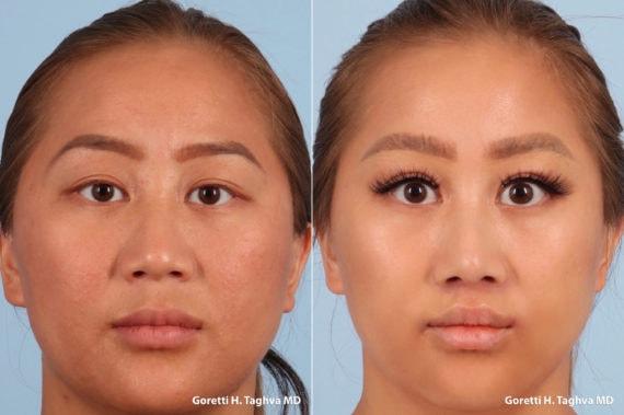 LEA Plastic Surgery - Goretti Ho Taghva MD, FACS rhinoplasty result — Newport Beach, CA