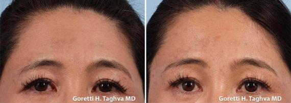 Brow Lift result at LEA Plastic Surgery - Goretti Ho Taghva MD, FACS in Newport Beach, CA