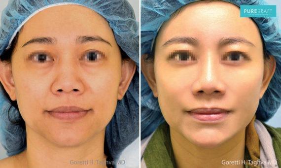 Brazilian Butt Lift result at LEA Plastic Surgery - Goretti Ho Taghva MD, FACS in Newport Beach, CA