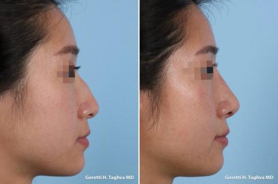 LEA Plastic Surgery - Goretti Ho Taghva MD, FACS rhinoplasty result — Newport Beach, CA