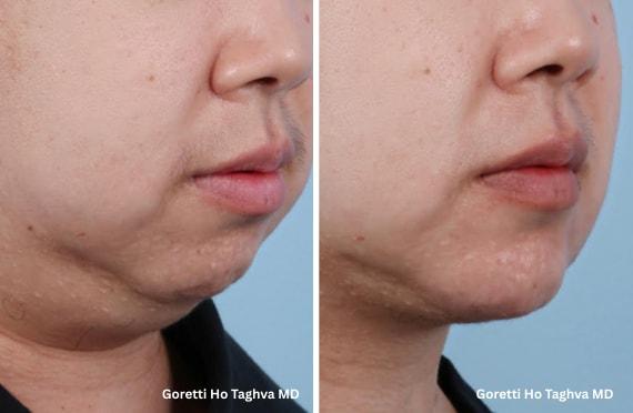 LEA Plastic Surgery - Goretti Ho Taghva MD, FACS neck liposuction result — Newport Beach, CA