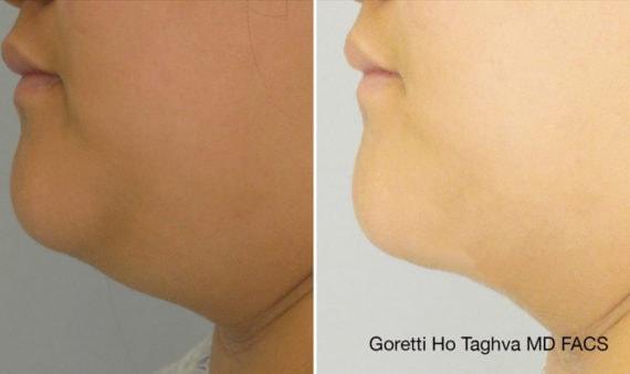 Neck Liposuction result at LEA Plastic Surgery - Goretti Ho Taghva MD, FACS in Newport Beach, CA