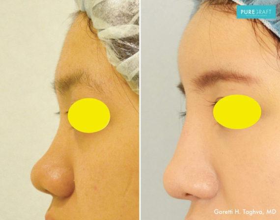 Brazilian Butt Lift result at LEA Plastic Surgery - Goretti Ho Taghva MD, FACS in Newport Beach, CA