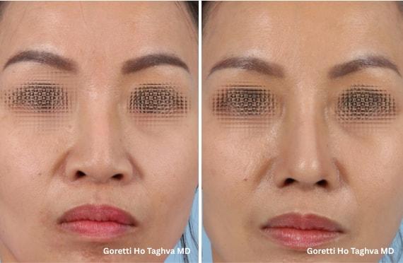LEA Plastic Surgery - Goretti Ho Taghva MD, FACS rhinoplasty result — Newport Beach, CA