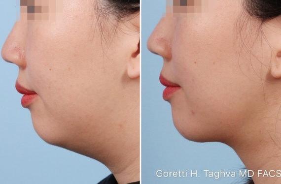 Neck Liposuction result at LEA Plastic Surgery - Goretti Ho Taghva MD, FACS in Newport Beach, CA