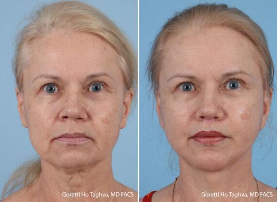 LEA Plastic Surgery - Goretti Ho Taghva MD, FACS facelift result — Newport Beach, CA