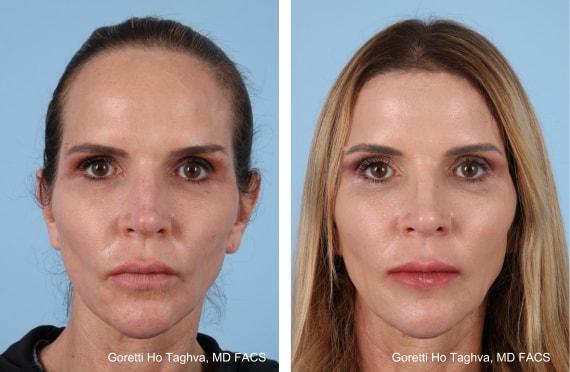 Brow Lift result at LEA Plastic Surgery - Goretti Ho Taghva MD, FACS in Newport Beach, CA