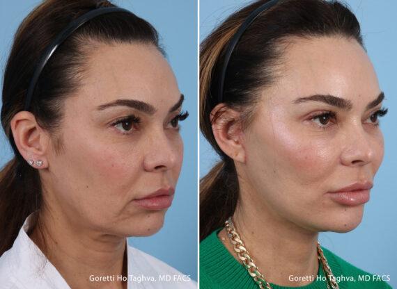 Facelift result at LEA Plastic Surgery - Goretti Ho Taghva MD, FACS in Newport Beach, CA