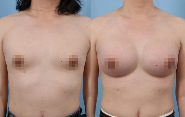 Breast Augmentation result at LEA Plastic Surgery - Goretti Ho Taghva MD, FACS in Newport Beach, CA