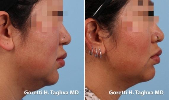 Neck Liposuction result at LEA Plastic Surgery - Goretti Ho Taghva MD, FACS in Newport Beach, CA