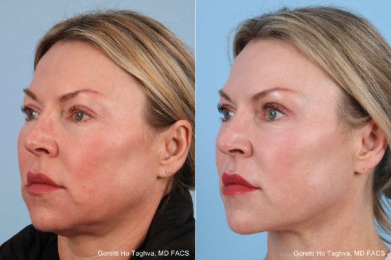LEA Plastic Surgery - Goretti Ho Taghva MD, FACS facelift result — Newport Beach, CA
