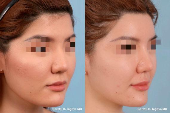 Brazilian Butt Lift result at LEA Plastic Surgery - Goretti Ho Taghva MD, FACS in Newport Beach, CA