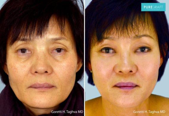 Brazilian Butt Lift result at LEA Plastic Surgery - Goretti Ho Taghva MD, FACS in Newport Beach, CA