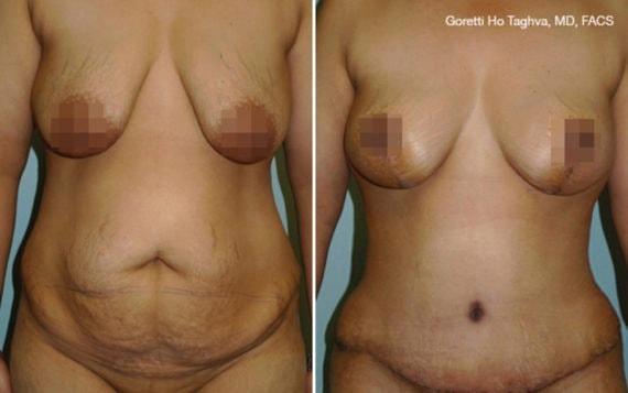 Mommy Makeover result at LEA Plastic Surgery - Goretti Ho Taghva MD, FACS in Newport Beach, CA