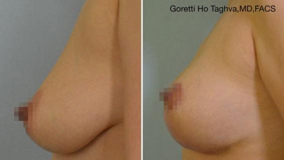 Breast Lift result at LEA Plastic Surgery - Goretti Ho Taghva MD, FACS in Newport Beach, CA
