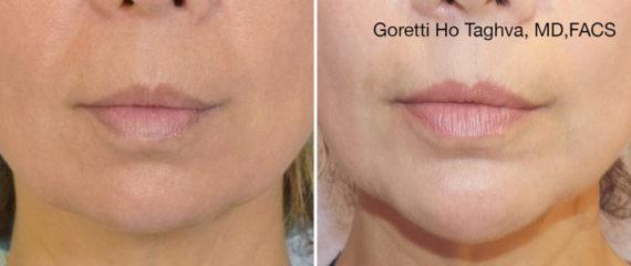 Breast Augmentation result at LEA Plastic Surgery - Goretti Ho Taghva MD, FACS in Newport Beach, CA