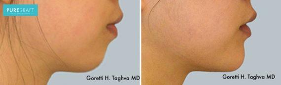 Brazilian Butt Lift result at LEA Plastic Surgery - Goretti Ho Taghva MD, FACS in Newport Beach, CA