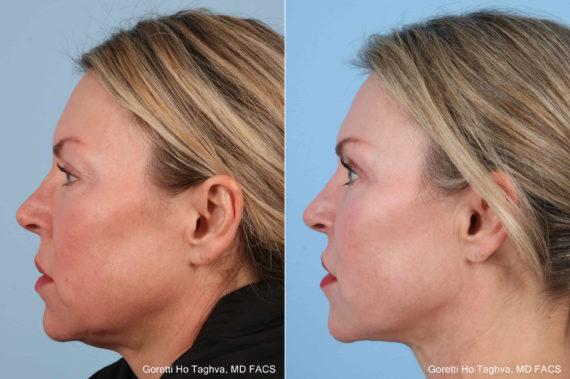 Facelift result at LEA Plastic Surgery - Goretti Ho Taghva MD, FACS in Newport Beach, CA