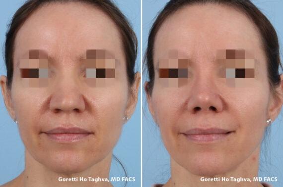 LEA Plastic Surgery - Goretti Ho Taghva MD, FACS rhinoplasty result — Newport Beach, CA