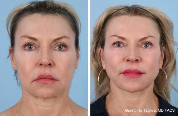 Facelift result at LEA Plastic Surgery - Goretti Ho Taghva MD, FACS in Newport Beach, CA