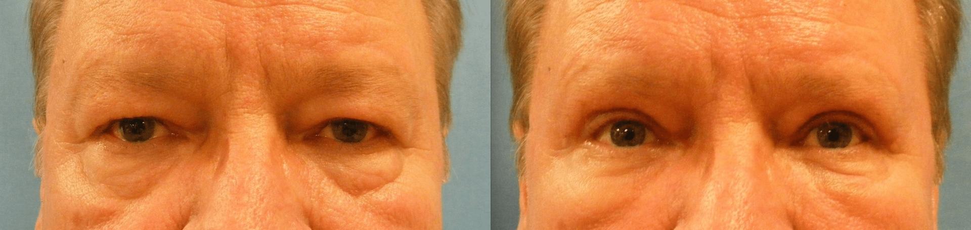 San Diego Surgical Arts eyelid lift result — San Diego, CA
